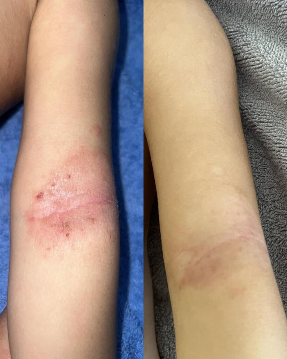 Is Beef Tallow Good for Eczema?